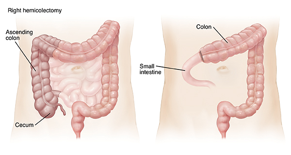 Outline of adult abdomen showing large and small intestines. Shaded area on left image shows right hemicolectomy. Outline of adult abdomen showing colon and small intestine connected after right hemicolectomy.