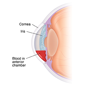 Cross section side view of front of eye showing blood in anterior chamber.