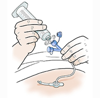 Close-up of hands connecting twist-on syringe to port on feeding tube.