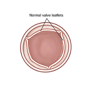 Top view of open pulmonary valve with normal leaflets.