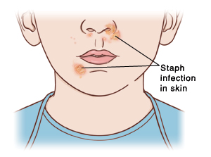 Closeup of lower face and neck. Staph infection sores on nose and near mouth.