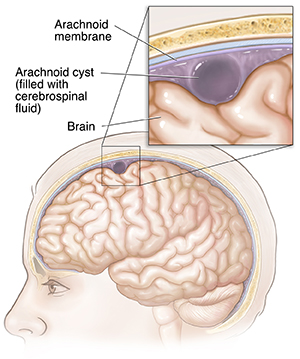 Side view of head and brain with a close-up of an arachnoid cyst.