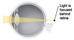 Cross section of eye showing light focusing in front of retina.