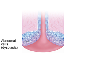 Cross section of cervix with dysplasia showing abnormal cells.