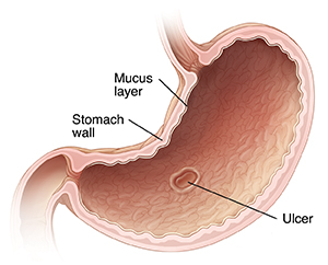 Cross section of stomach showing ulcer.