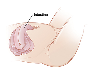 Closeup of infant abdomen showing bowel coming through defect in abdomen.