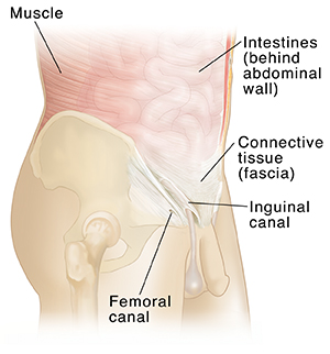 Side view of male torso showing abdominal muscles and intestines. Umbilical ring and internal inguinal ring are visible.