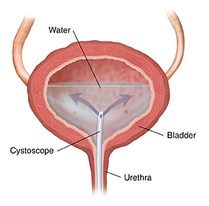 Cross section of bladder showing catheter inserted through ureter, releasing water into bladder.