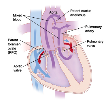 Four-chamber view of heart showing transposition of the great arteries. Arrows indicate blood flow through heart.