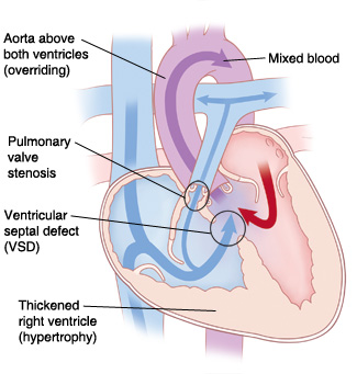 Cross section of heart showing Tetralogy of Fallot.