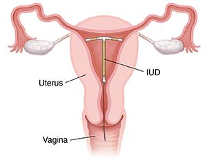 Cross section of uterus and vagina showing IUD in place inside uterus.