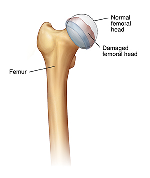 Front view of top part of femur with damaged femoral head. Dotted line shows rounded shape of normal femoral head.