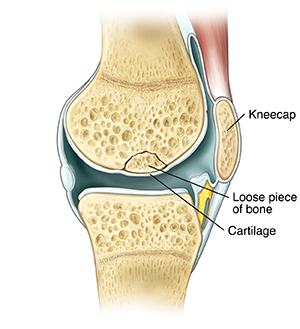 Closeup of knee joint showing loose piece of bone broken off from leg bone but underneath cartilage.