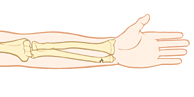 Lower arm bones showing greenstick fracture of wrist.