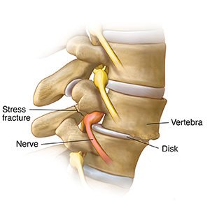 Side view of lumbar spine showing spondylolisthesis and stress fracture.