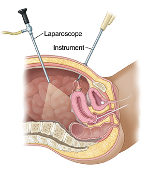 Cross section of female pelvis from the side showing laparoscopy.