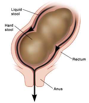 Close up cross section of rectum and anus showing liquid stool leaking around hard stool.