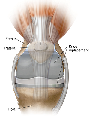 Front view of knee joint with total knee replacement.