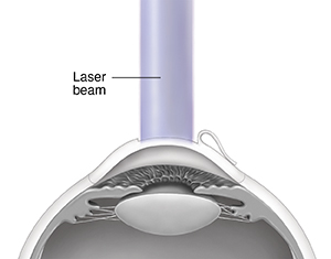 Cross section of eye showing laser beam reshaping cornea under flap.