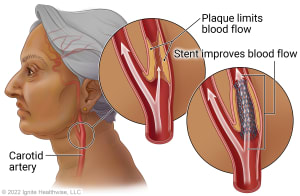 Side view of a person's head and neck showing the carotid artery. An inset shows the cut view of a carotid artery narrowed by plaque, and another inset shows the cut view of a carotid artery with a stent in place.