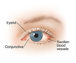 Front view of eye showing red eye.