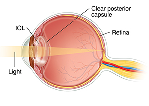 Side view cross section of front of eye showing intraocular lens in posterior capsule.