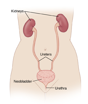 Front view of female torso, showing kidneys connected to neobladder by ureters.