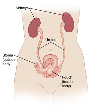 Front view of female torso, showing kidneys connected to pouch and stoma by ureters.