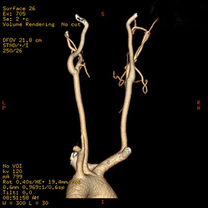 Computed tomography angiogram of carotid arteries.
