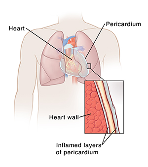 Outline of human chest showing heart and pericardium. Closeup cross section showing two layers of inflamed pericardium with fluid in between them on top of heart wall.