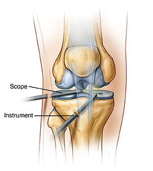 Front view of knee showing arthroscope and instrument inserted into joint.