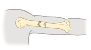 Upper arm bone showing a segmental fracture.