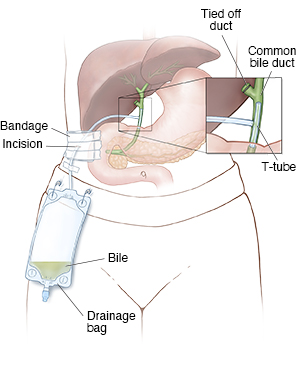 Front view of torso showing liver, stomach, and pancreas with a t-tube and bag in place for drainage. Inset shows close-up of t-tube in bile duct.