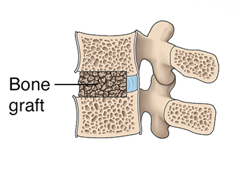 Cross section of lumbar vertebrae showing bone graft between vertebrae.