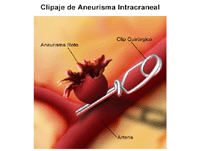 Ilustración de un clipaje de aneurisma cerebral