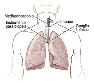 Vista frontal del pecho en el que puede verse un mediastinoscopio insertado en el pecho a través de la incisión.