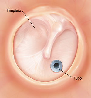 Tímpano con un tubo del lado inferior izquierdo.