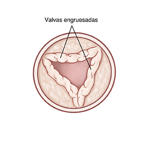 Vista superior de válvula pulmonar abierta con valvas engrosadas.