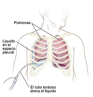 Vista frontal del pecho de un hombre donde se observa una sonda que drena el líquido del espacio al lado del pulmón.