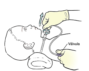 Niño acostado boca arriba con una almohada debajo del cuello. Una mano enguantada hace girar un catéter y lo quita del tubo de traqueostomía. El dedo gordo de la otra mano está sobre la válvula.