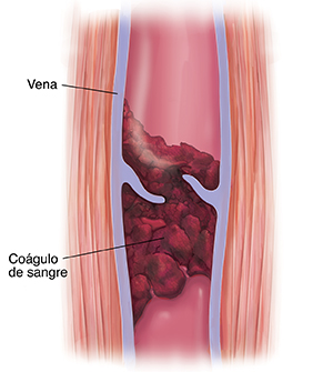 Corte transversal de músculo y vena con coágulo sanguíneo.