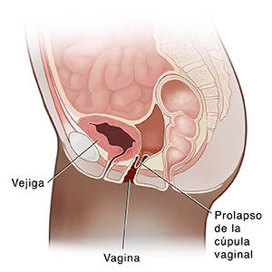 Vista lateral de corte transversal de la pelvis femenina donde se observa una histerectomía.