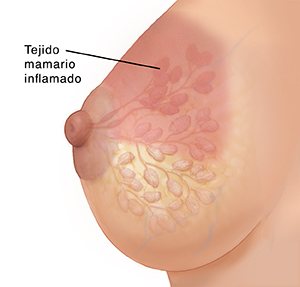 Vista lateral de una mama femenina con los conductos y los lobulillos en imagen fantasma; la piel y las glándulas se ven inflamadas.