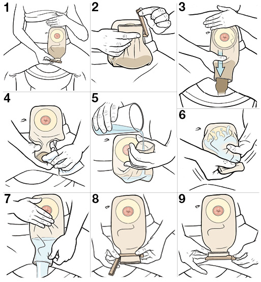 9 steps for emptying the pouch for your stoma