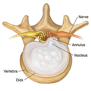 Top view of lumbar vertebra showing contained herniated disk.