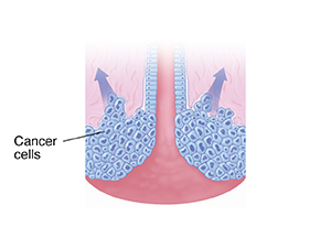 Cross section of cervix with arrows showing spread of cancer cells.