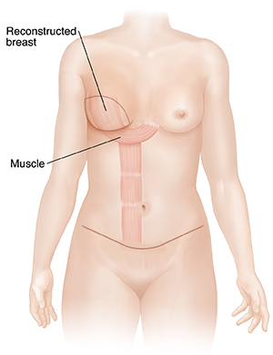 Front view of female breasts and abdomen showing TRAM flap breast reconstruction.
